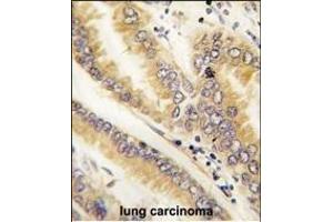 Formalin-fixed and paraffin-embedded human lung carcinoma tissue reacted with AGR2 antibody (N-term) (ABIN390226 and ABIN2840703) , which was peroxidase-conjugated to the secondary antibody, followed by DAB staining. (AGR2 Antikörper  (N-Term))