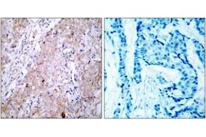 Immunohistochemistry analysis of paraffin-embedded human breast carcinoma tissue, using EGFR (Ab-1070) Antibody. (EGFR Antikörper  (AA 1041-1090))
