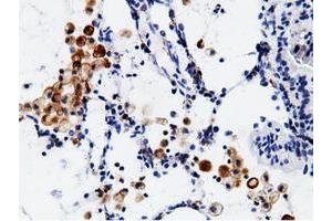 Immunohistochemical staining of paraffin-embedded Adenocarcinoma of Human breast tissue using anti-CD80 mouse monoclonal antibody. (CD80 Antikörper)