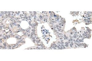 Immunohistochemistry of paraffin-embedded Human colorectal cancer tissue using TCEB2 Polyclonal Antibody at dilution of 1:40(x200) (TCEB2 Antikörper)