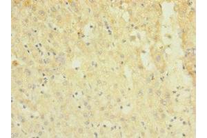 Immunohistochemistry of paraffin-embedded human liver cancer using ABIN7172869 at dilution of 1:100 (TRPM7 Antikörper  (AA 756-855))