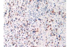 IHC-P analysis of Human Stomach Cancer Tissue, with DAB staining. (HSPD1 Antikörper  (AA 172-343))