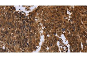 Immunohistochemistry of paraffin-embedded Human cervical cancer using FGFRL1 Polyclonal Antibody at dilution of 1:40 (FGFRL1 Antikörper)