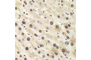 Immunohistochemistry of paraffin-embedded human liver injury using HNRNPD Antibody (ABIN5970929) at dilution of 1/100 (40x lens). (HNRNPD/AUF1 Antikörper)