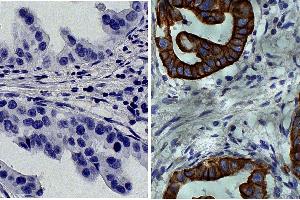 Paraffin embedded human gastric cancer tissue was stained with Mouse IgG2a-HRP isotype control followed by DAB and hematoxylin. (Cytokeratin 19 Antikörper  (C-Term))