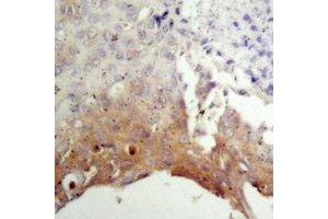 Immunohistochemical analysis of TSC2 staining in human prostate cancer formalin fixed paraffin embedded tissue section. (Tuberin Antikörper)