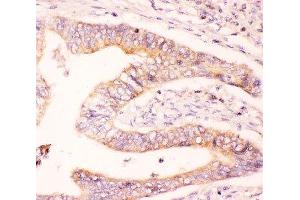 IHC-P: MCL1 antibody testing of human intestine cancer tissue (MCL-1 Antikörper  (AA 1-350))