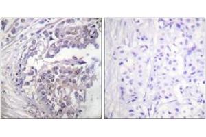 Immunohistochemistry analysis of paraffin-embedded human breast carcinoma tissue, using Histone H2B (Acetyl-Lys5) Antibody. (Histone H2B Antikörper  (acLys5))