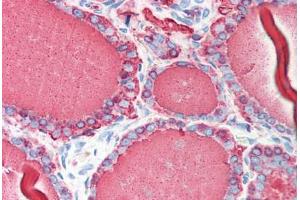 Human Thyroid (formalin-fixed, paraffin-embedded) stained with TG antibody ABIN214384 at 5 ug/ml followed by biotinylated anti-mouse IgG secondary antibody ABIN481714, alkaline phosphatase-streptavidin and chromogen. (Thyroglobulin Antikörper)