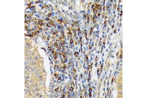 Immunohistochemistry of paraffin-embedded human esophageal cancer using V Rabbit mAb (ABIN7271305) at dilution of 1:100 (40x lens). (VAV3 Antikörper)