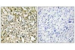 Immunohistochemistry analysis of paraffin-embedded human liver carcinoma tissue using Myc antibody. (c-MYC Antikörper  (C-Term))