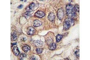 IHC analysis of FFPE human hepatocarcinoma tissue stained with PDGFR antibody (PDGFRA Antikörper  (AA 698-727))