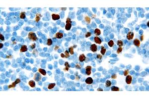 Human chronic lymphocytic leukemia: immunohistochemical staining for Geminin. (Geminin Antikörper  (AA 5-209))