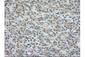 Immunohistochemical staining of paraffin-embedded Carcinoma of kidney tissue using anti-BUB1Bmouse monoclonal antibody. (BUB1B Antikörper)