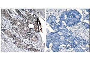 Immunohistochemical analysis of paraffin-embedded human breast carcinoma tissue using p53 (phospho- Ser6) antibody (E011092). (p53 Antikörper  (pSer6))