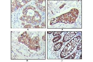 Immunohistochemical analysis of paraffin-embedded human breast carcinoma(A), lung cancer(B) and normal colon tissue(C), showing cytoplasmic localization with DAB staining using KRT19 mouse mAb. (Cytokeratin 19 Antikörper)