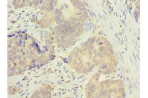 Immunohistochemistry of paraffin-embedded human gastric cancer using ABIN7165819 at dilution of 1:100 (MSTO1 Antikörper  (AA 1-280))