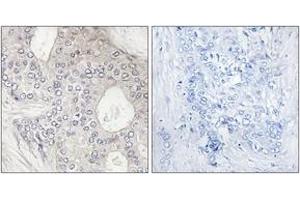 Immunohistochemistry analysis of paraffin-embedded human breast carcinoma tissue, using Cytochrome P450 1A2 Antibody. (CYP1A2 Antikörper  (AA 331-380))