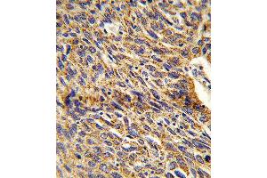 Formalin-fixed and paraffin-embedded human lung carcinoma reacted with DCI Antibody , which was peroxidase-conjugated to the secondary antibody, followed by DAB staining. (DCI Antikörper  (C-Term))