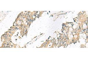 Immunohistochemistry of paraffin-embedded Human colorectal cancer tissue using MGAT4B Polyclonal Antibody at dilution of 1:50(x200) (MGAT4B Antikörper)
