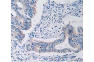 Detection of TFR in Human Rectum Cancer Tissue using Anti-Transferrin Receptor (TFR) Polyclonal Antibody (Transferrin Receptor Antikörper  (AA 567-744))