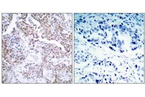 Immunohistochemical analysis of paraffin-embedded human breast carcinoma tissue using p53 (phospho- Ser15) antibody (E011094). (p53 Antikörper  (pSer15))