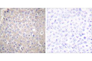 Peptide - +Immunohistochemical analysis of paraffin-embedded human breast carcinoma tissue using E-cadherin antibody. (E-cadherin Antikörper)