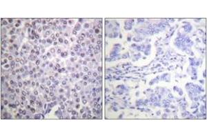 Immunohistochemistry analysis of paraffin-embedded human breast carcinoma tissue, using Histone H4 (Ab-12) Antibody. (Histone H4 Antikörper  (AA 10-59))