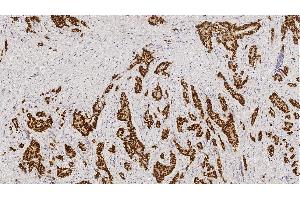 Left: Invasive ductal carcinoma (high expressor): intense nuclear staining in nearly 100 % of tumor cells. (Estrogen Receptor alpha Antikörper)