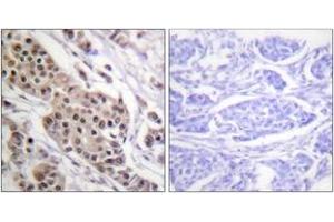 Immunohistochemistry analysis of paraffin-embedded human breast carcinoma, using p53 (Phospho-Ser392) Antibody. (p53 Antikörper  (pSer392))