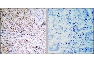 Immunohistochemistry (IHC) image for anti-Retinoblastoma Protein (Rb Protein) (pSer795) antibody (ABIN2888520) (Retinoblastoma Protein (Rb) Antikörper  (pSer795))
