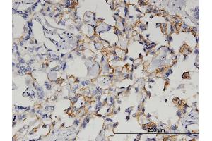 Immunoperoxidase of monoclonal antibody to QPCT on formalin-fixed paraffin-embedded human breast cancer. (QPCT Antikörper  (AA 262-359))