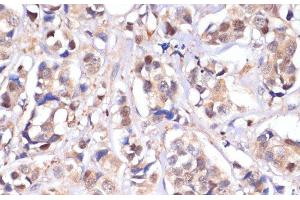 Immunohistochemistry of paraffin-embedded Human breast cancer using STK4 Polyclonal Antibody at dilution of 1:100 (40x lens). (STK4 Antikörper)