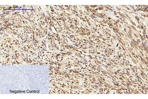 Immunohistochemical analysis of paraffin-embedded human uterus cancer tissue. (Calnexin Antikörper)