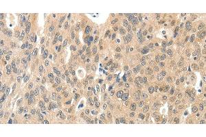 Immunohistochemistry of paraffin-embedded Human ovarian cancer tissue using ROS1 Polyclonal Antibody at dilution 1:40 (ROS1 Antikörper)