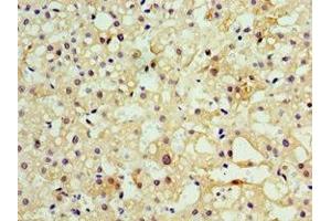 Immunohistochemistry of paraffin-embedded human liver cancer using ABIN7160457 at dilution of 1:100 (MOG Antikörper  (AA 30-154))