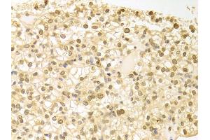 Immunohistochemistry of paraffin-embedded human kidney cancer using PLCB1 antibody (ABIN5971022) at dilution of 1/100 (40x lens). (Phospholipase C beta 1 Antikörper)