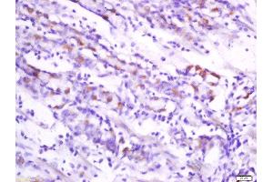 Formalin-fixed and paraffin embedded human stomach carcinoma labeled withAnti-Folate Receptor 4 Polyclonal Antibody, Unconjugated  at 1:200 followed by conjugation to the secondary antibody and DAB staining. (Folate Receptor 4 Antikörper)