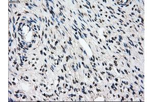 Immunohistochemical staining of paraffin-embedded Adenocarcinoma of breast tissue using anti-PSMD10 mouse monoclonal antibody. (PSMD10 Antikörper)