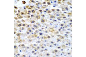 Immunohistochemistry of paraffin-embedded human liver cancer using TFPI2 antibody (ABIN5975010) at dilution of 1/200 (40x lens). (TFPI2 Antikörper)