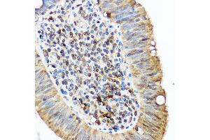 Immunohistochemistry of paraffin-embedded human lung cancer using /IB Rabbit pAb (2391) at dilution of 1:50 (40x lens). (Iba1 Antikörper  (AA 1-147))