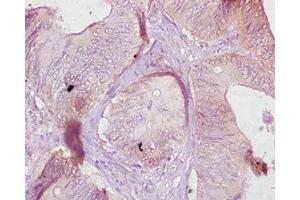 Immunohistochemistry of paraffin-embedded human colon cancer using ABIN7177073 at dilution of 1:10 (CES1C Antikörper  (AA 19-550))