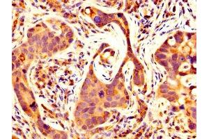 IHC image of ABIN7159063 diluted at 1:500 and staining in paraffin-embedded human pancreatic cancer performed on a Leica BondTM system. (MMP14 Antikörper  (AA 112-582))