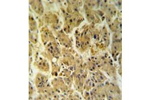 Immunohistochemistryanalysis in formalin fixed and paraffin embedded hepatocarcinoma reacted with NDUFS2 Antibody (Center) followed which was peroxidase conjugated to the secondary antibody and followed by DAB staining. (NDUFS2 Antikörper  (Middle Region))