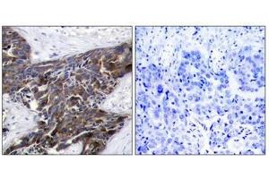 Immunohistochemical analysis of paraffin-embedded human breast carcinoma tissue using Connexin 43(Phospho-Ser367) Antibody(left) or the same antibody preincubated with blocking peptide(right). (Connexin 43/GJA1 Antikörper  (pSer368))