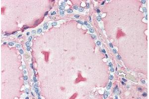 Human Thyroid (formalin-fixed, paraffin-embedded) stained with TG antibody ABIN396965 at 10 ug/ml followed by biotinylated anti-mouse IgG secondary antibody ABIN481714, alkaline phosphatase-streptavidin and chromogen. (Thyroglobulin Antikörper)