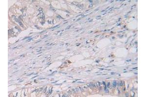 IHC-P analysis of Human Rectum Cancer Tissue, with DAB staining. (Cathepsin S Antikörper  (AA 115-331))