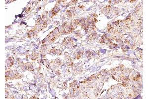 ABIN6274832 at 1/100 staining Human breast cancer tissue by IHC-P. (ACER3 Antikörper  (Internal Region))
