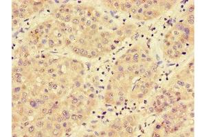 Immunohistochemistry of paraffin-embedded human liver cancer using ABIN7159112 at dilution of 1:100 (MED17 Antikörper  (AA 411-651))