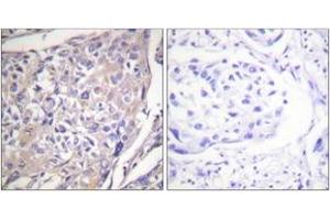 Immunohistochemistry analysis of paraffin-embedded human breast carcinoma, using p70 S6 Kinase (Phospho-Ser418) Antibody. (RPS6KB1 Antikörper  (pSer418))